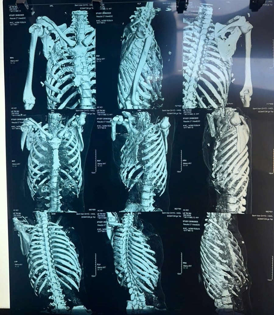 Hình ảnh chụp CT dựng hình vùng tổn thương của bệnh nhân L.T.N.