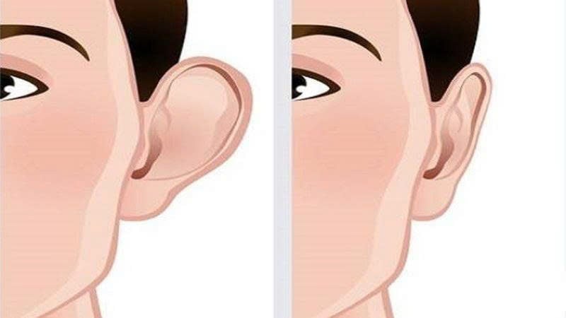 Hình tai vểnh (bên trái) và tai bình thường (bên phải)