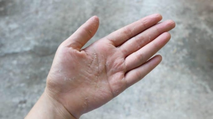 Thói quen tẩy rửa hàng ngày khiến da bị bong tróc (Ảnh minh họa)  