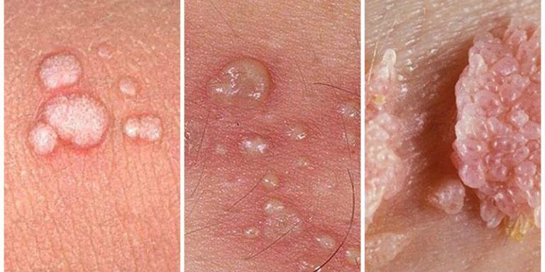 Một trong những biểu hiện thường gặp khi nam giới nhiễm HPV là sùi mào gà xuất hiện ở da quy đầu (Ảnh minh họa)