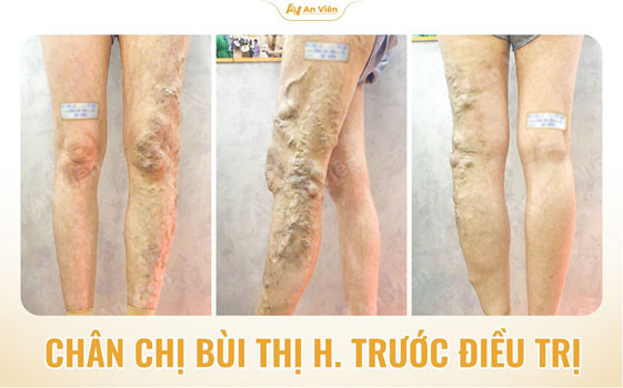 Tình trạng chân ban đầu của bệnh nhân khi tới khám