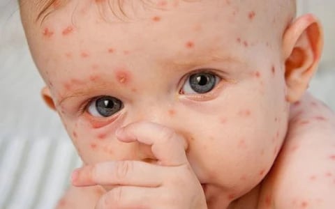 Những biến chứng sởi ở trẻ không thể xem nhẹ