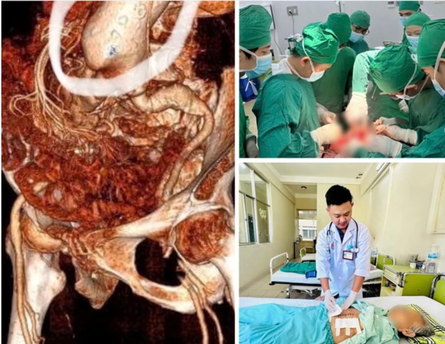 Ê-kíp bác sĩ Khoa Ngoại lồng ngực của bệnh viện vừa phẫu thuật thành công, cứu sống một cụ bà bị vỡ phình động mạch chủ bụng ( Ảnh: BVCC )