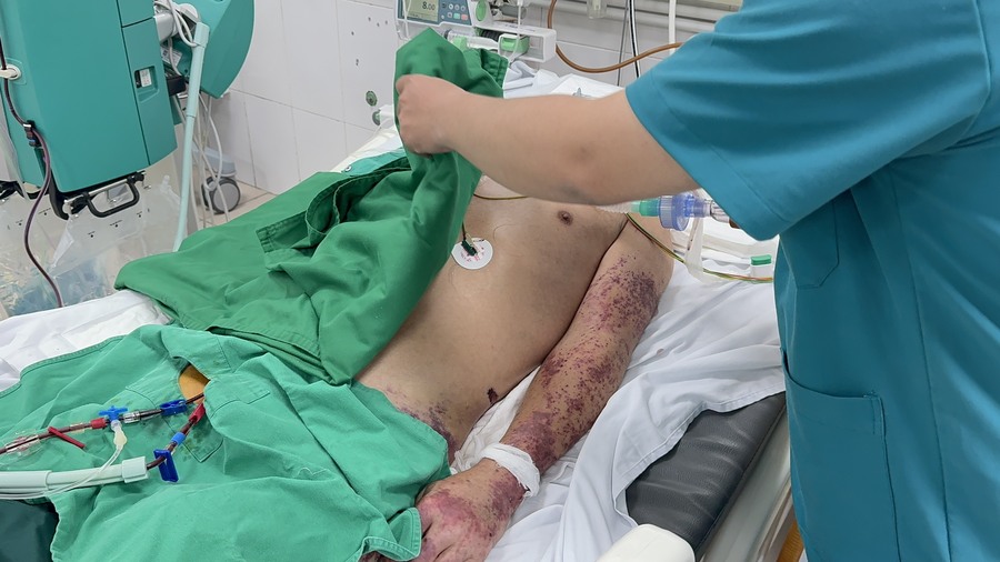 Bệnh viện Bạch Mai đã ghi nhận 3 trường hợp nghi nhiễm liên cầu lợn liên quan tới chùm bệnh phát sinh tại Hưng Yên chỉ trong 2 tuần đầu tháng 7