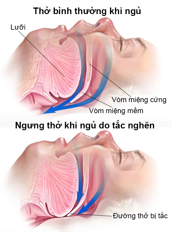Hình ảnh đường hô hấp trên bình thường, luồng khí thở thông thoáng và đường hô hấp trên khi bị tắc nghẽn. Ảnh: VnExpress