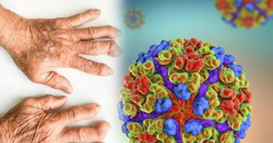 Dịch bệnh Chikungunya là một bệnh do virus truyền qua muỗi gây sốt và đau khớp nặng, đang có xu hướng gia tăng ở nhiều quốc gia