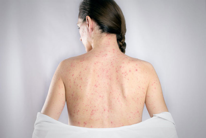 Phát ban toàn thân do virus sởi gây ra (Ảnh: Sưu tầm)