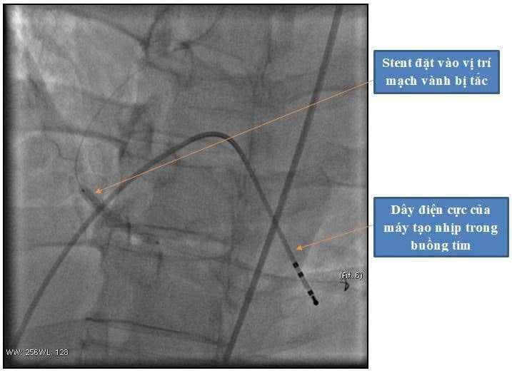Hình ảnh động mạch vành đã được tái thông sau khi đặt stent