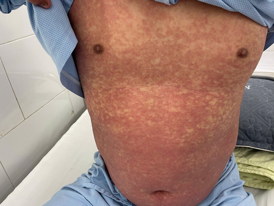Hình ảnh phát ban toàn thân trên bệnh nhân dị ứng thuốc nặng do Phenylbutazone (Ảnh: bệnh viện Bạch Mai cung cấp)