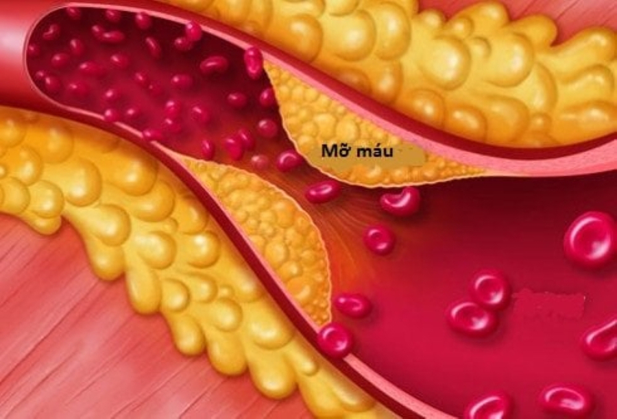 Mỡ máu gây nên nhiều chứng bệnh ở người cao tuổi (Ảnh minh họa)    