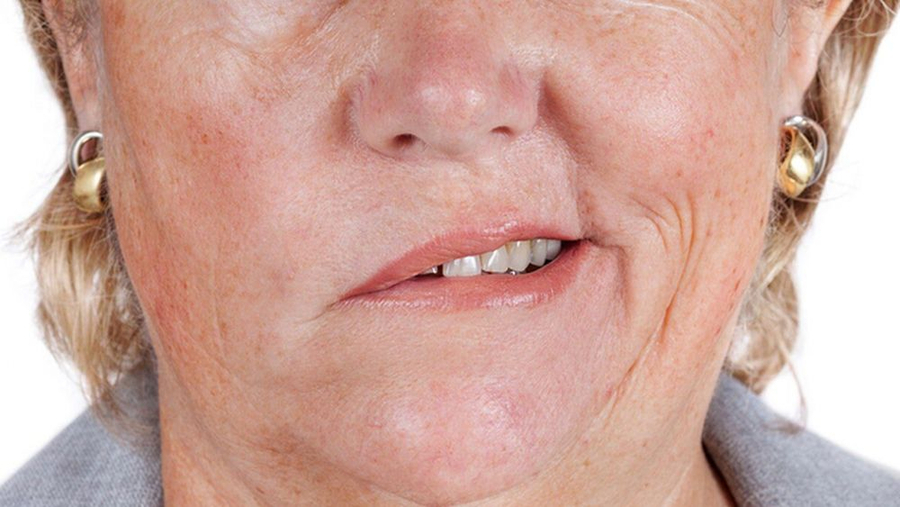Mặt xệ một bên, méo miệng là biểu hiện của đột quỵ (Ảnh minh họa)