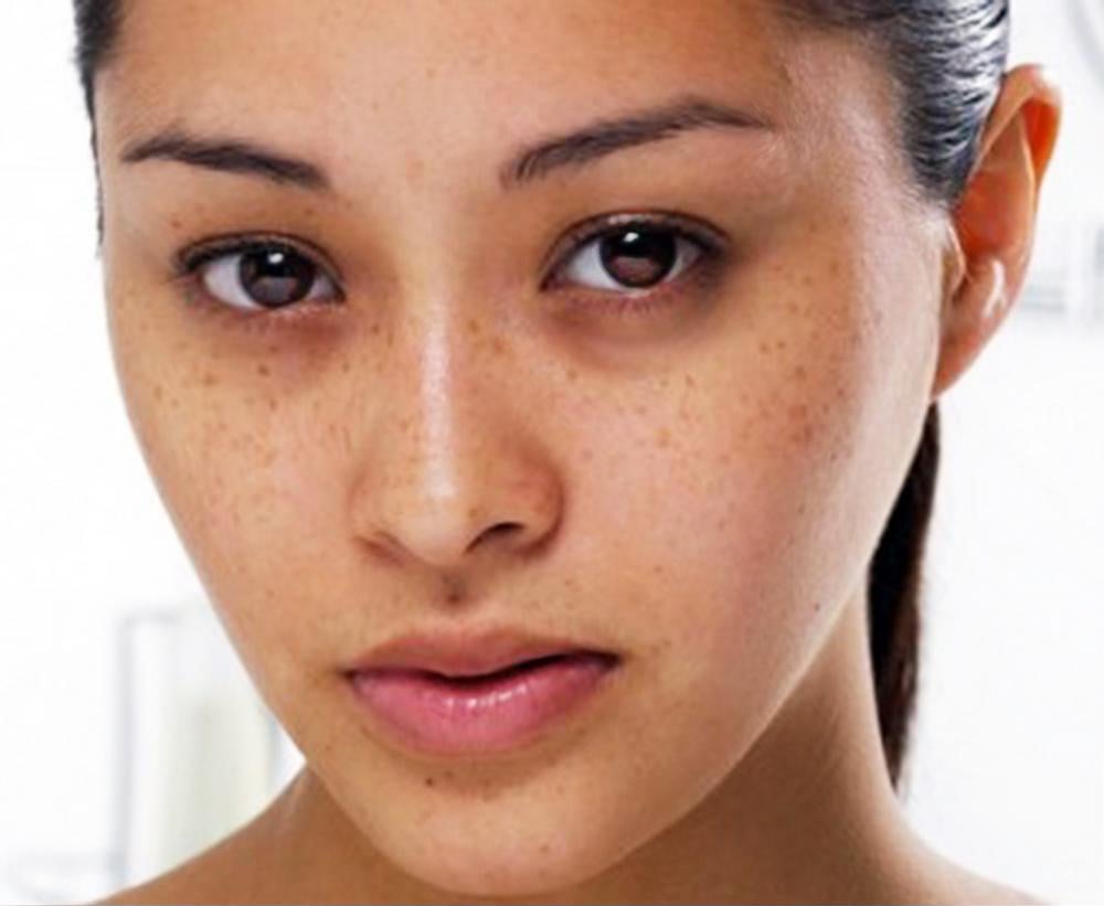 Khi cơ thể sản sinh nhiều melanin sẽ dẫn tới tàn nhang (Ảnh minh họa)