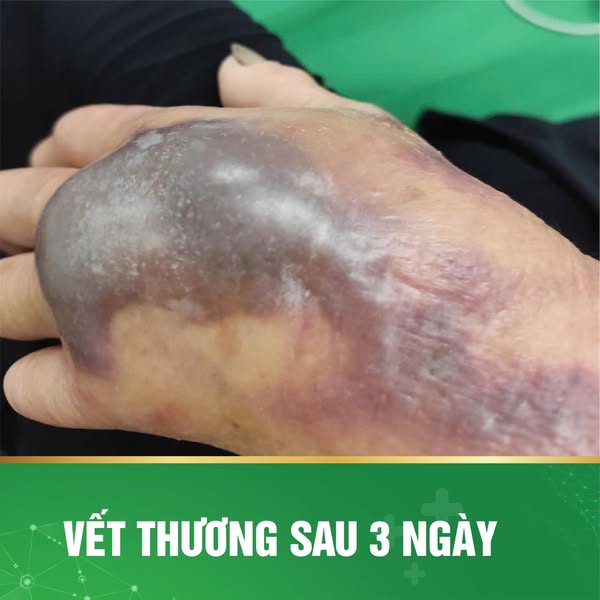 Hình ảnh vết thương sau 3 ngày (Ảnh: BVĐKTP Vinh)