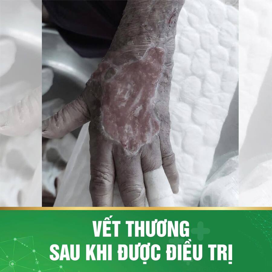 Vết thương sau khi được điều trị (Ảnh: BVCC)