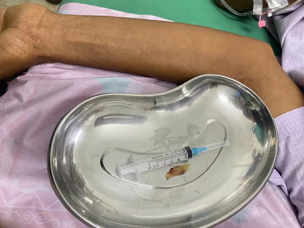 Hình ảnh mảnh xương gà dài khoảng 4,5 cm đang đâm chặt vào thực quản 