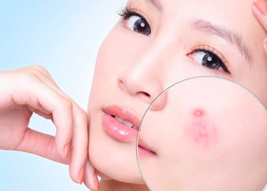 Ưu tiên lựa các sản phẩm không chứa dầu cho da mụn (Ảnh minh họa)  