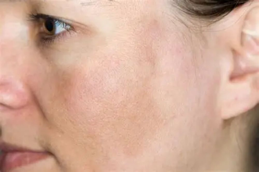 Stress lâu ngày dẫn đến tình trạng xấu cho làn da (Ảnh minh họa)   