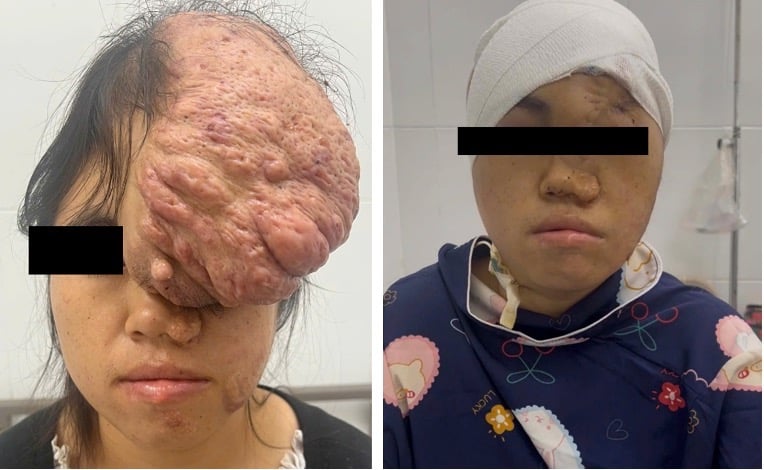 Khuôn mặt của nữ dân tộc Mông bị biến dạng nghiêm trọng. Ảnh: Sở Y tế TP.Hồ Chí Minh