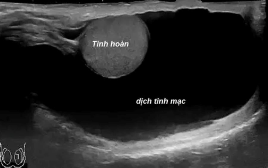 Tràn dịch màng tinh hoàn (Ảnh minh họa)