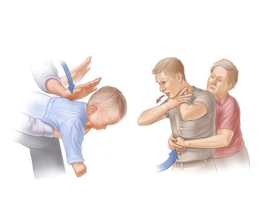 Ngạt thở do hóc dị vật là một tình huống vô cùng nguy hiểm (Ảnh minh họa)   