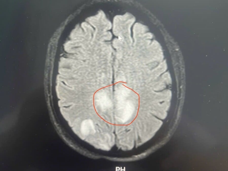 Hình ảnh chụp MRI sọ não của bệnh nhân Bùi Thị T.