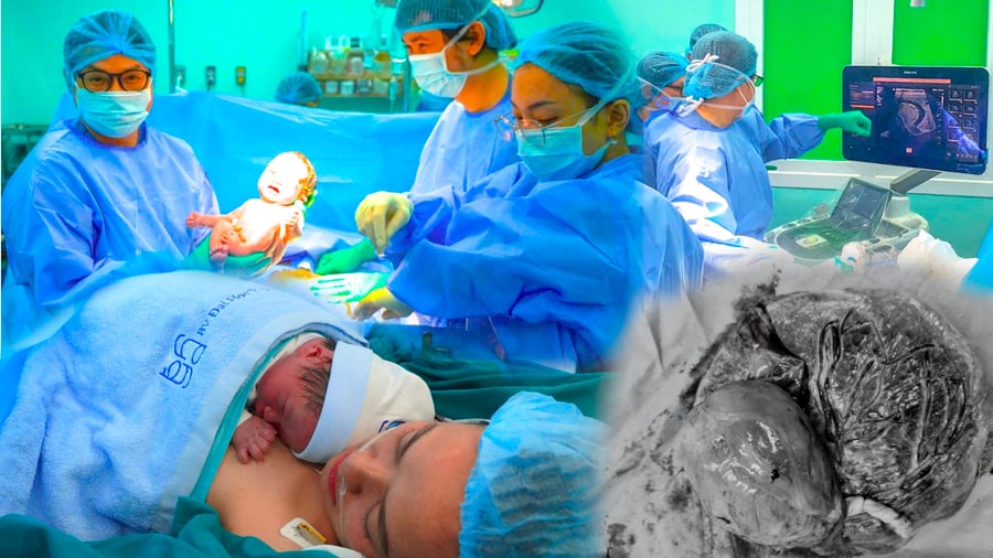 Ê - kíp Bệnh viện Đại học Y Dược can thiệp thành công, cứu sống thai nhi mắc khối u nhau thai khổng lồ (Ảnh: BVCC)