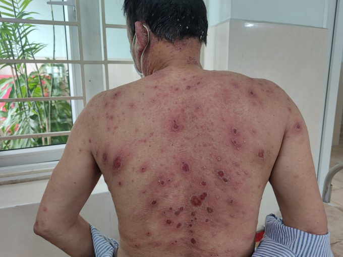 Tổn thương ở da của bệnh nhân. Ảnh: BVCC