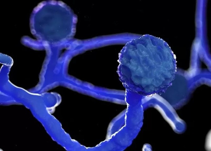Hình ảnh nấm đen Mucormycosis