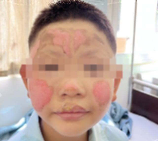 Bé trai bị tổn thương vùng mặt do bật lửa nổ. Ảnh: BVCC