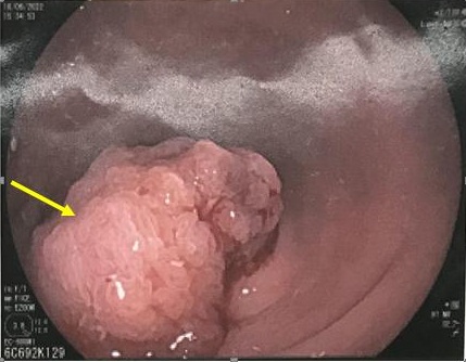 polyp_truc_trang