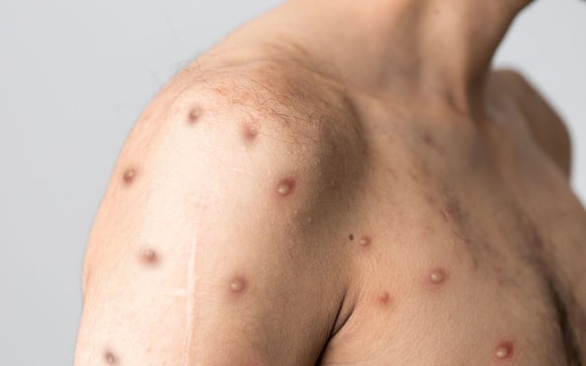 skynews-monkeypox-disease5831864-166513187456363628975-crop-16651318823981306740883