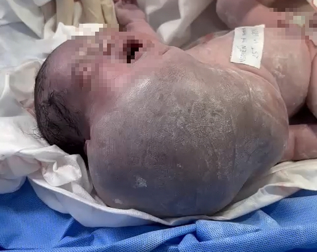 Khối bướu khủng đã chèn ép khí quản và lan xuống vùng ngực, phổi khiến bé thở không được. Ảnh: BVCC