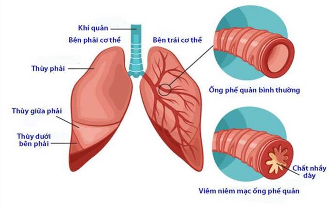 tai-sao-viem-phe-quan-man-tinh-van-tai-