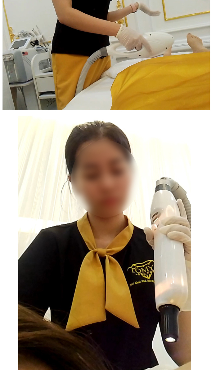 Nhân viên TOMY’S SECRET triệt lông và trị viêm nang lông cho cô H.Tr vào 2 ngày 04/6 và 12/6/2022