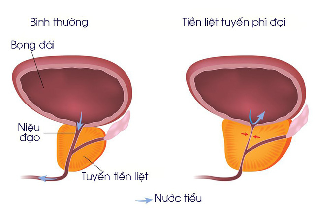 Bệnh nhân phì đại tuyến tiền liệt. Ảnh minh họa