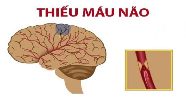 Bệnh thiếu máu não có điều trị được bằng thuốc nam. Ảnh: TTVN