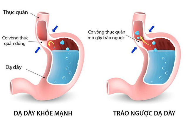 Mối quan hệ giữa trào ngược dạ dày thực quản và viêm loét dạ dày. Ảnh minh họa