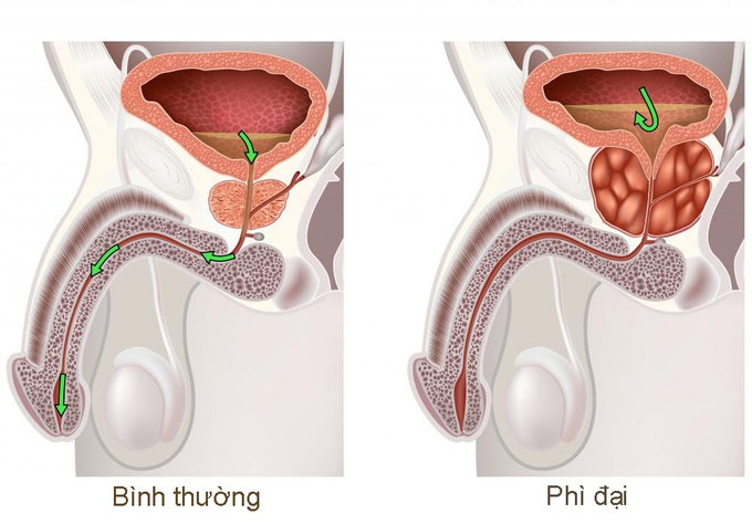 phi-dai-tuyen-tien-liet