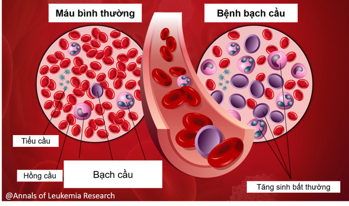 leukemia-768x453