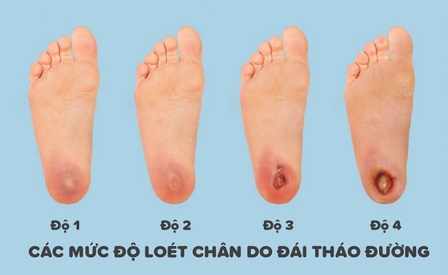 loet-tieu-duong-3