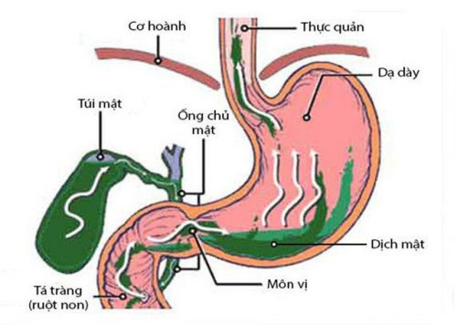 Mối quan hệ giữa trào ngược dịch mật và trào ngược dạ dày thực quản. Ảnh: Nội khoa Việt Nam