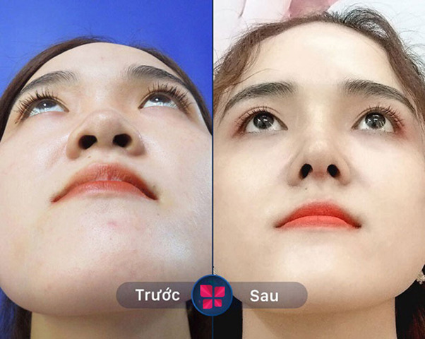 mui 5