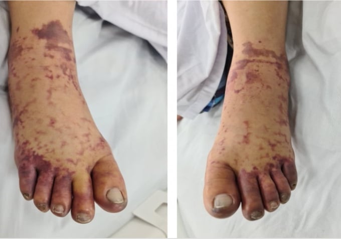Tổn thương ở chân người bệnh sau 2 ngày vào viện. Ảnh: BVCC