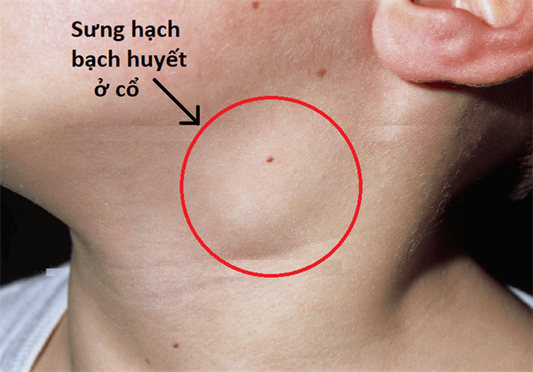 trieu-chung-ung-thu-hach-non-hodgkin