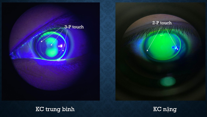Bệnh lý Giác mạc chóp (KC)