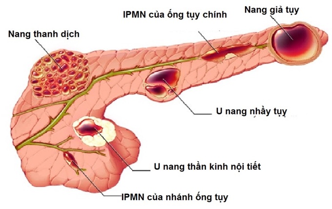 benh-ly-tuy-072429-110723-23