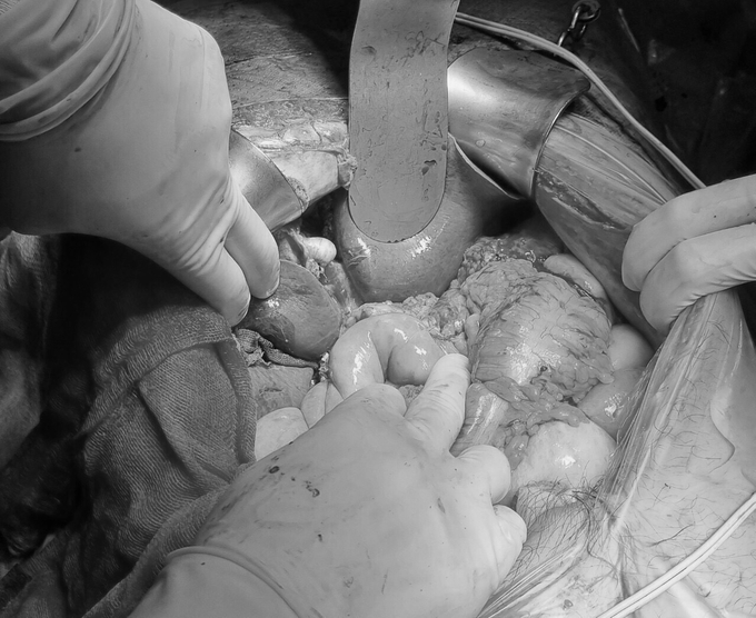 Bác sĩ tiến hành mổ cấp cứu khẩn cấp