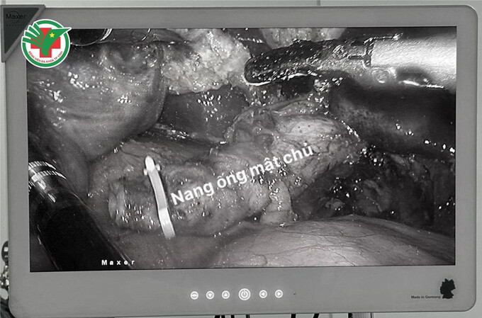 Trường hợp nang ống mật chủ được Bệnh viện Đa khoa TP.Vinh điều trị thành công. Ảnh: Bệnh viện ĐKTP. Vinh cung cấp