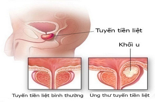 ung thu tien liejt tuyen