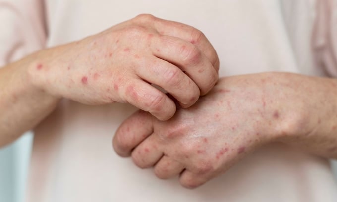 skin-allergy-person-s-arm-1-16-2704-2778-1696221535